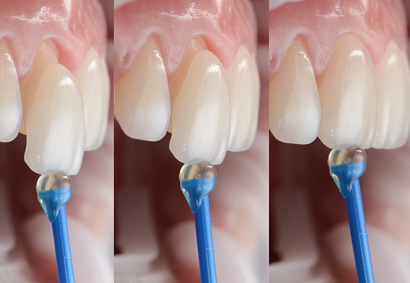 dental veneers vietnam