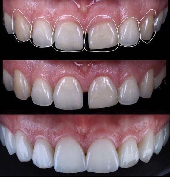veneer răng sứ tại bedental