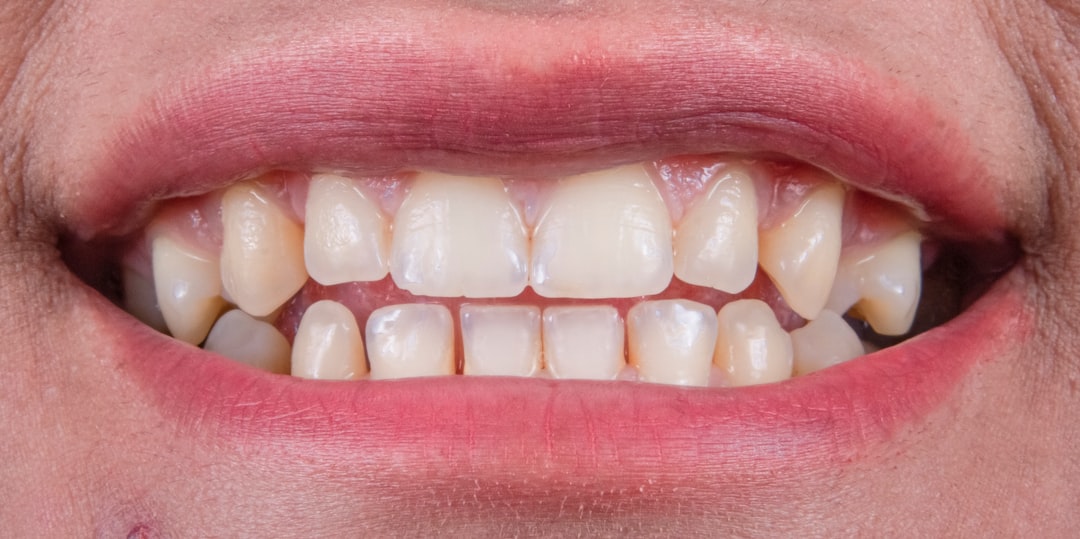 Crown replacement at BeDental Vietnam