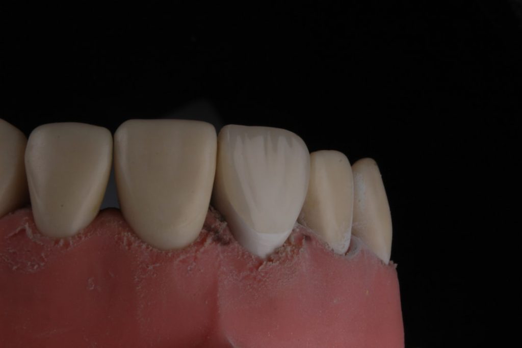 Crown at BeDental Vietnam
