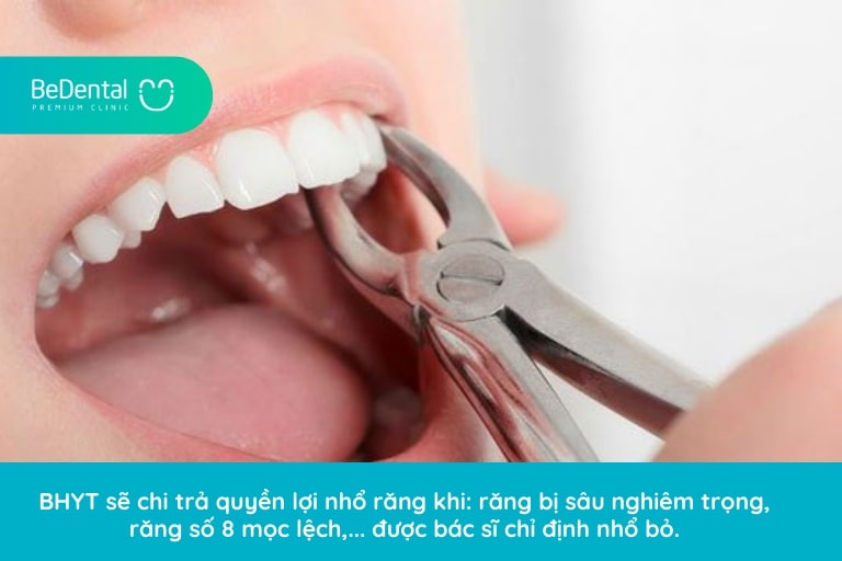 nhổ răng bệnh lý có được bảo hiểm y tế không