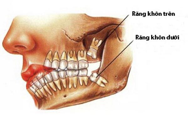 nhổ răng khôn bệnh lý