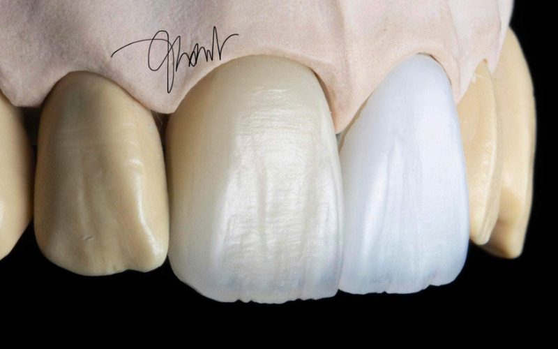 veneer răng sứ tại bedental