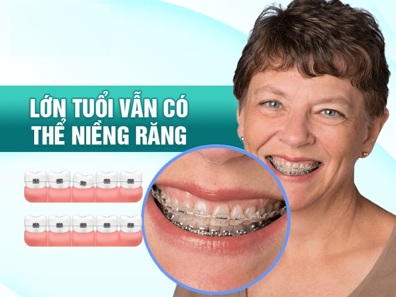 niềng răng cho người lớn tuổi