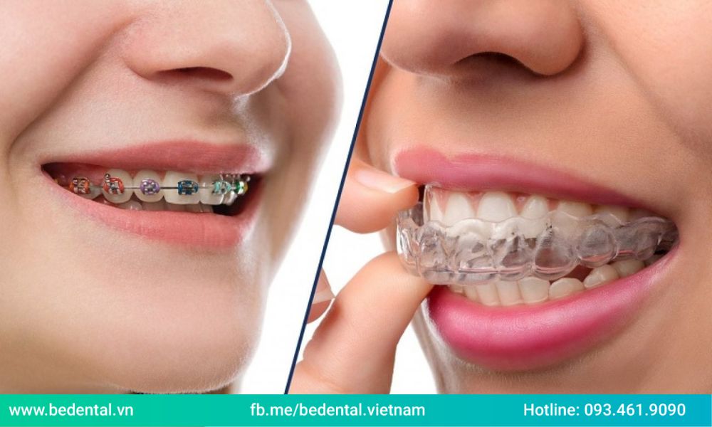 niềng răng invisalign và niềng răng mắc cài