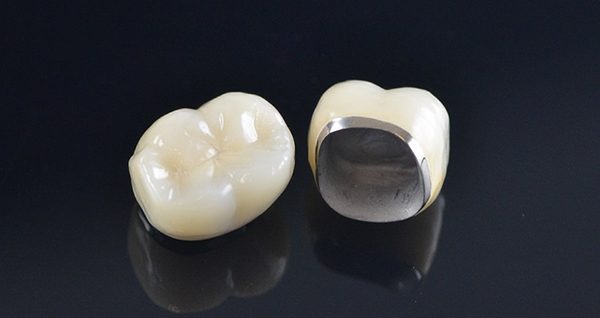 Emax Porcelain Teeth in Vietnam