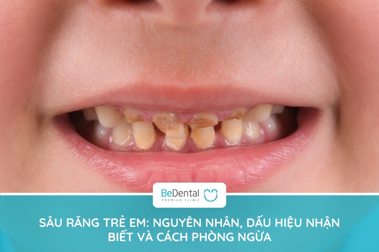 sâu răng nguyên nhân do chế độ sinh hoạt sai cách