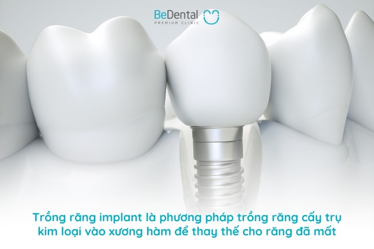 trong rang implant 1