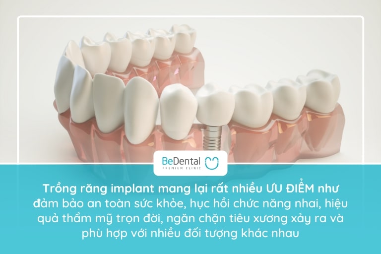 cấy implant răng tại Bedental