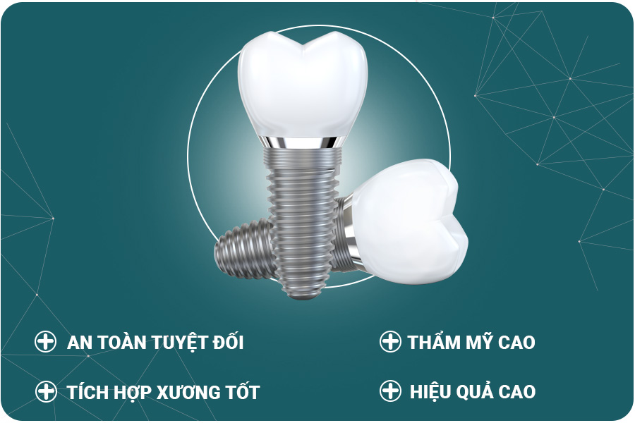 cấy implant răng tại Bedental