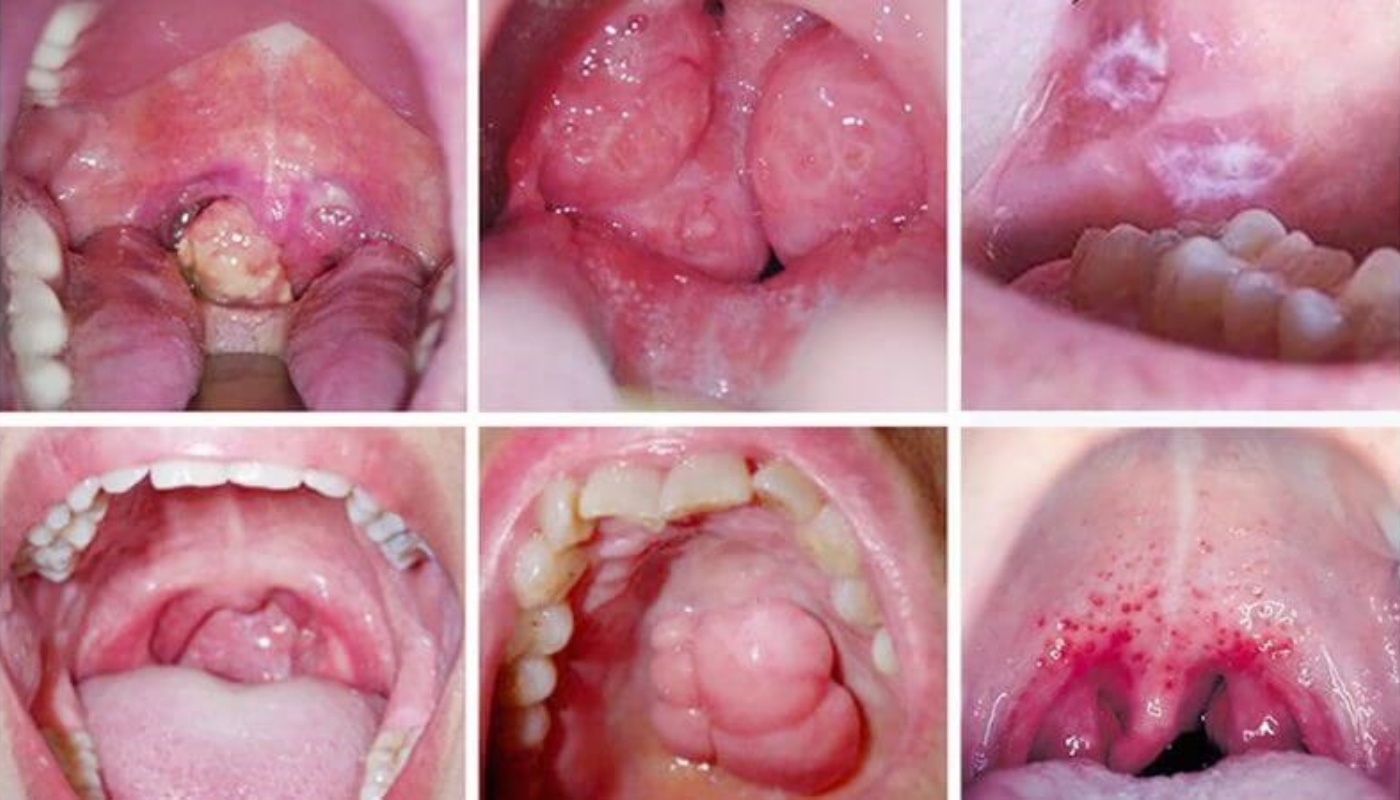 Mụn Và Sức Khỏe Răng Miệng: Mối Liên Hệ Khoa Học Và Cách Chăm Sóc Đúng 7 mụn và sức khỏe răng miệng có liên quan đến nhau