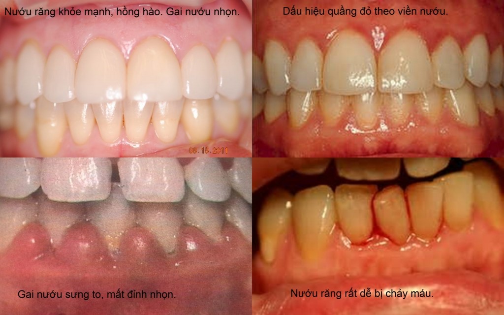 viêm nướu răng
